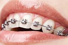 Ortodonti nedir ? Antalya ortodonti